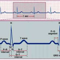 تشخیص آریتمی قلبی با استفاده سیگنال ECG و طبقه بندی آن با KNN